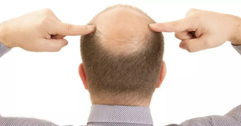 hair loss becomes more common